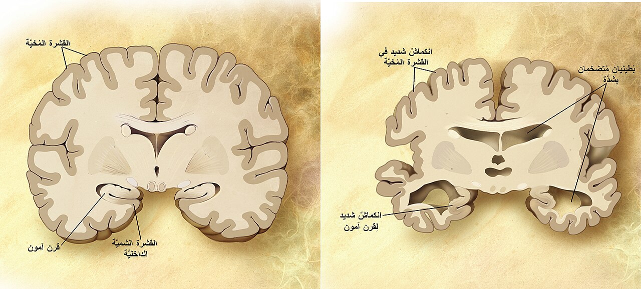 Alzheimer's disease brain comparison-ar.jpg