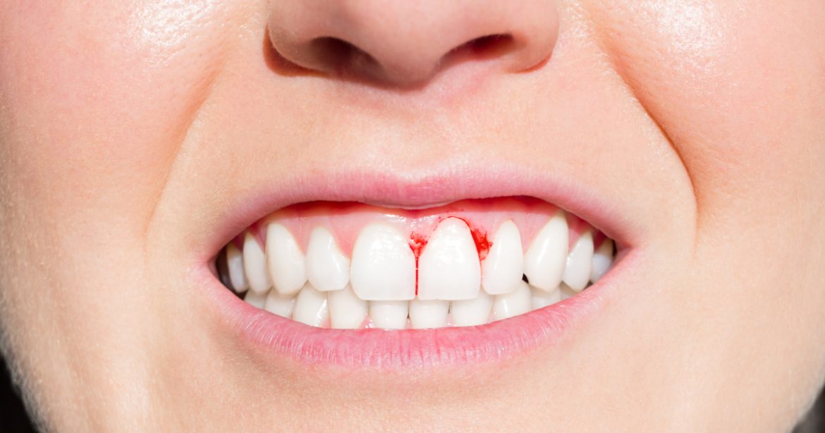 The Link Between Childhood Oral Health and Heart Disease